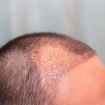 haartransplantation