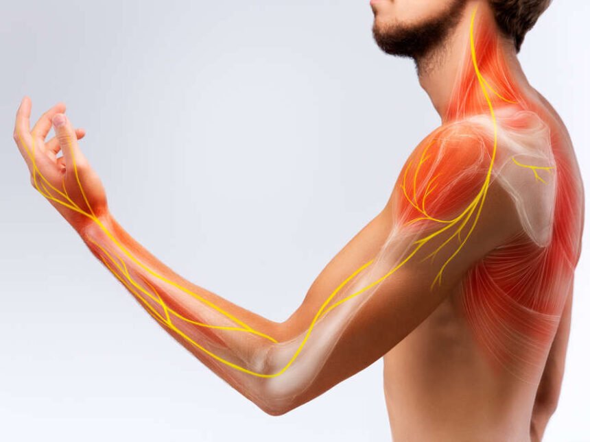 névralgie cervico-brachiale